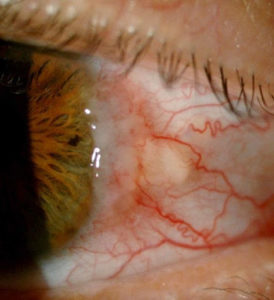 Ocular Surface Squamous Neoplasia (OSSN) - Dr Boon Ham