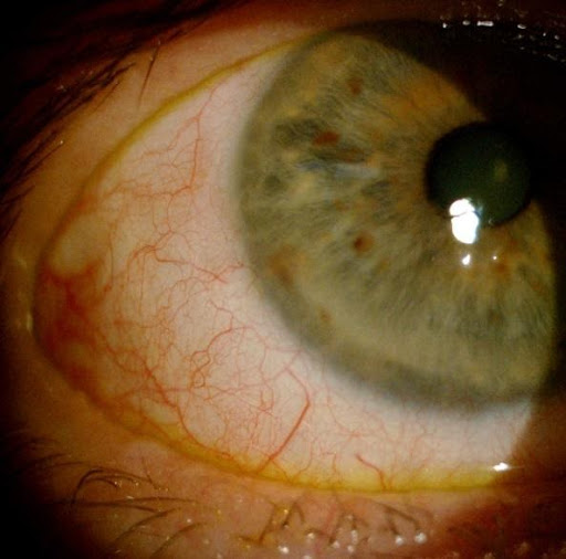 Ocular Surface Squamous Neoplasia (OSSN) - Dr Boon Ham