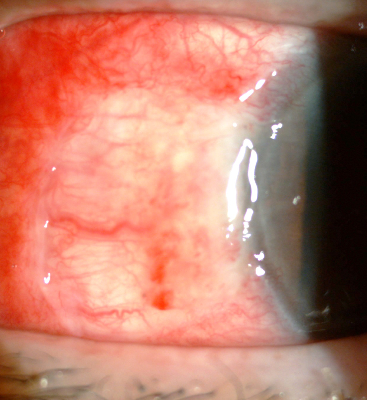 Ocular Surface Squamous Neoplasia (OSSN) - Dr Boon Ham